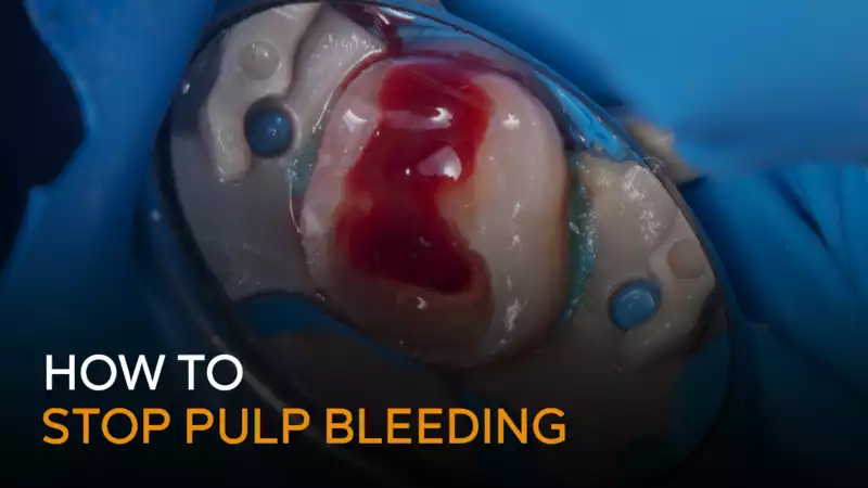 11.How to stop pulp bleeding-title