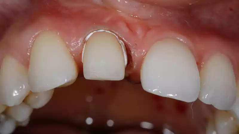 vertiPrep-tricks4dentists-9