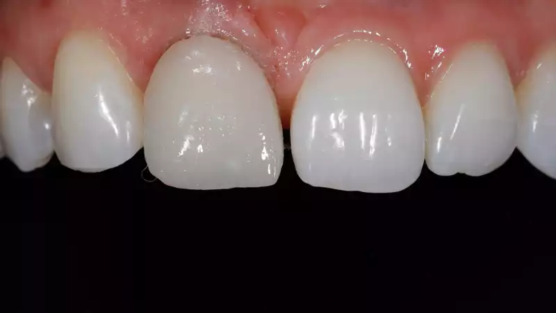 vertiPrep-tricks4dentists-10