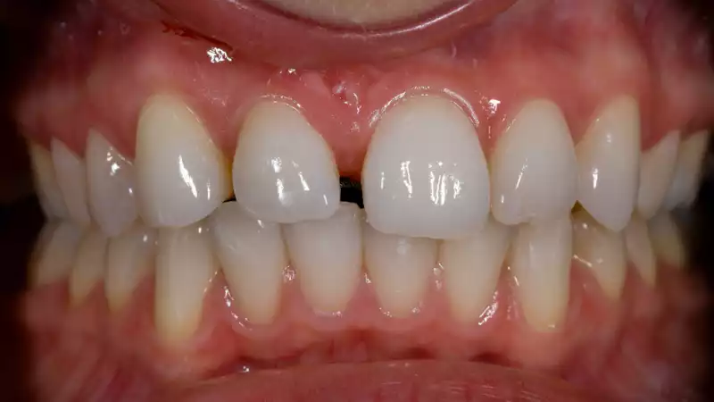 vertiPrep-tricks4dentists-2