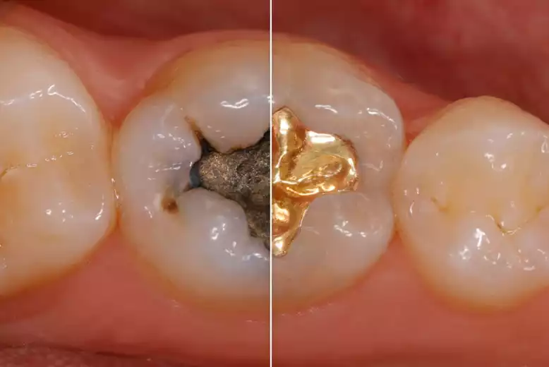 cast_gold_restoration