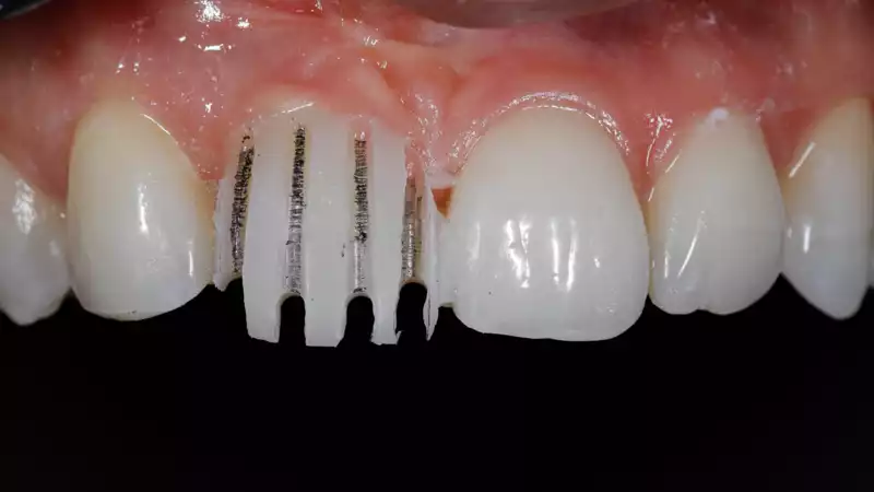 vertiPrep-tricks4dentists-6