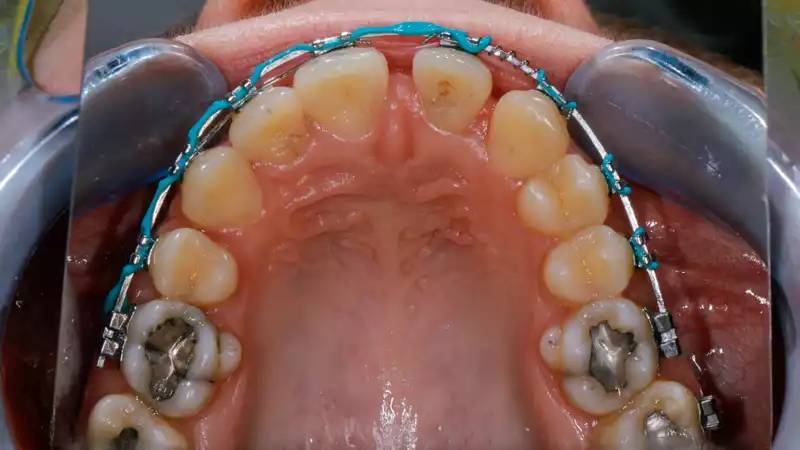 vertiPrep-tricks4dentists-1