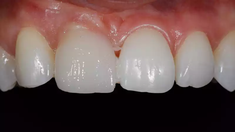 vertiPrep-tricks4dentists-4