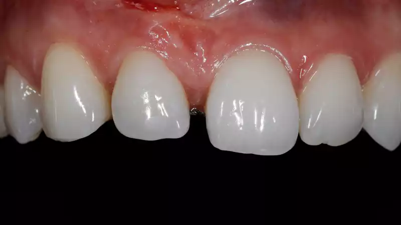 vertiPrep-tricks4dentists-3