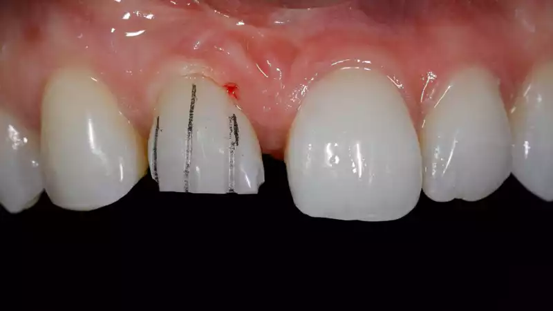 vertiPrep-tricks4dentists-7