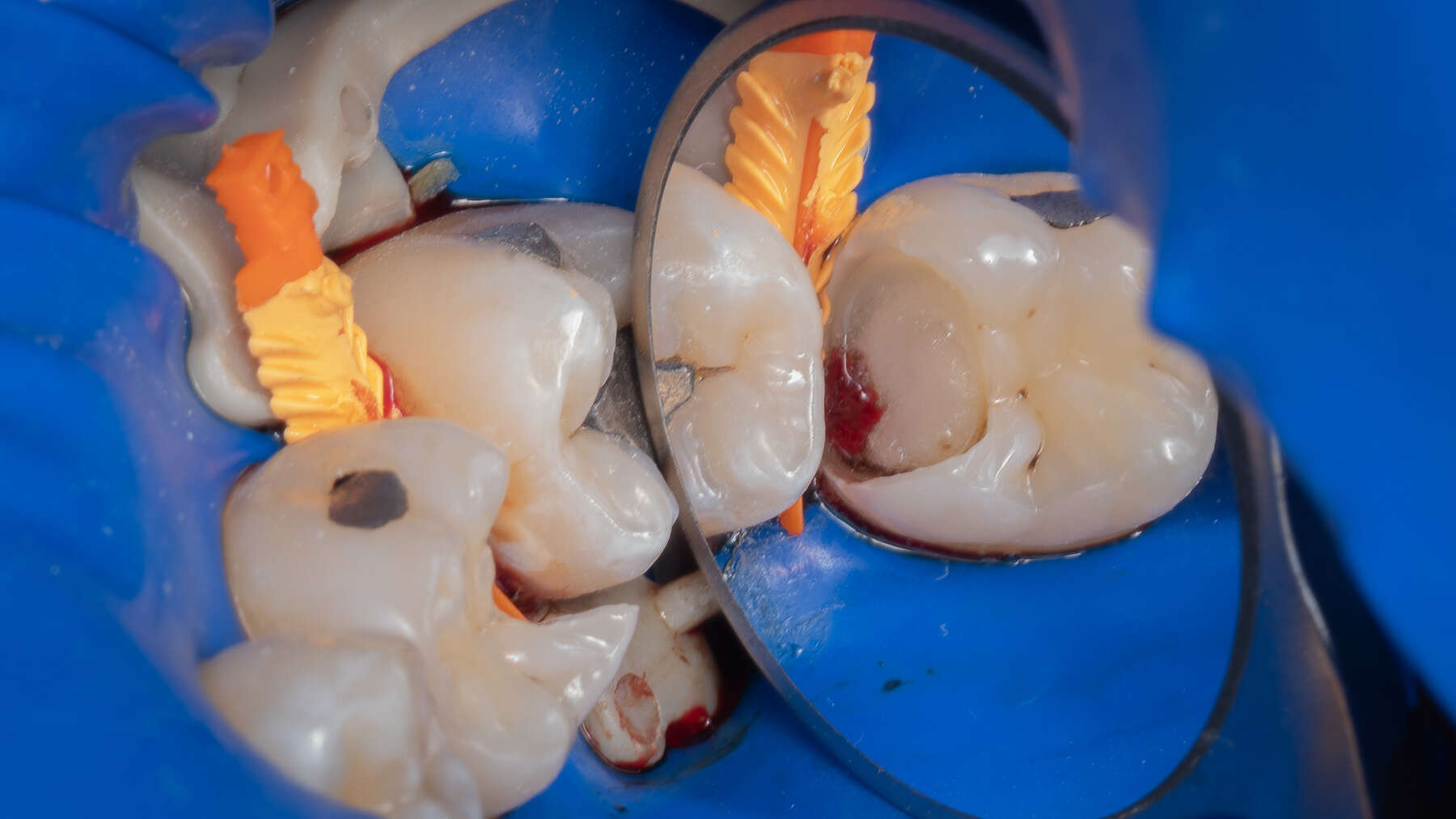 Vital pulp therapy (VPT) procedure, indications and clinical technique