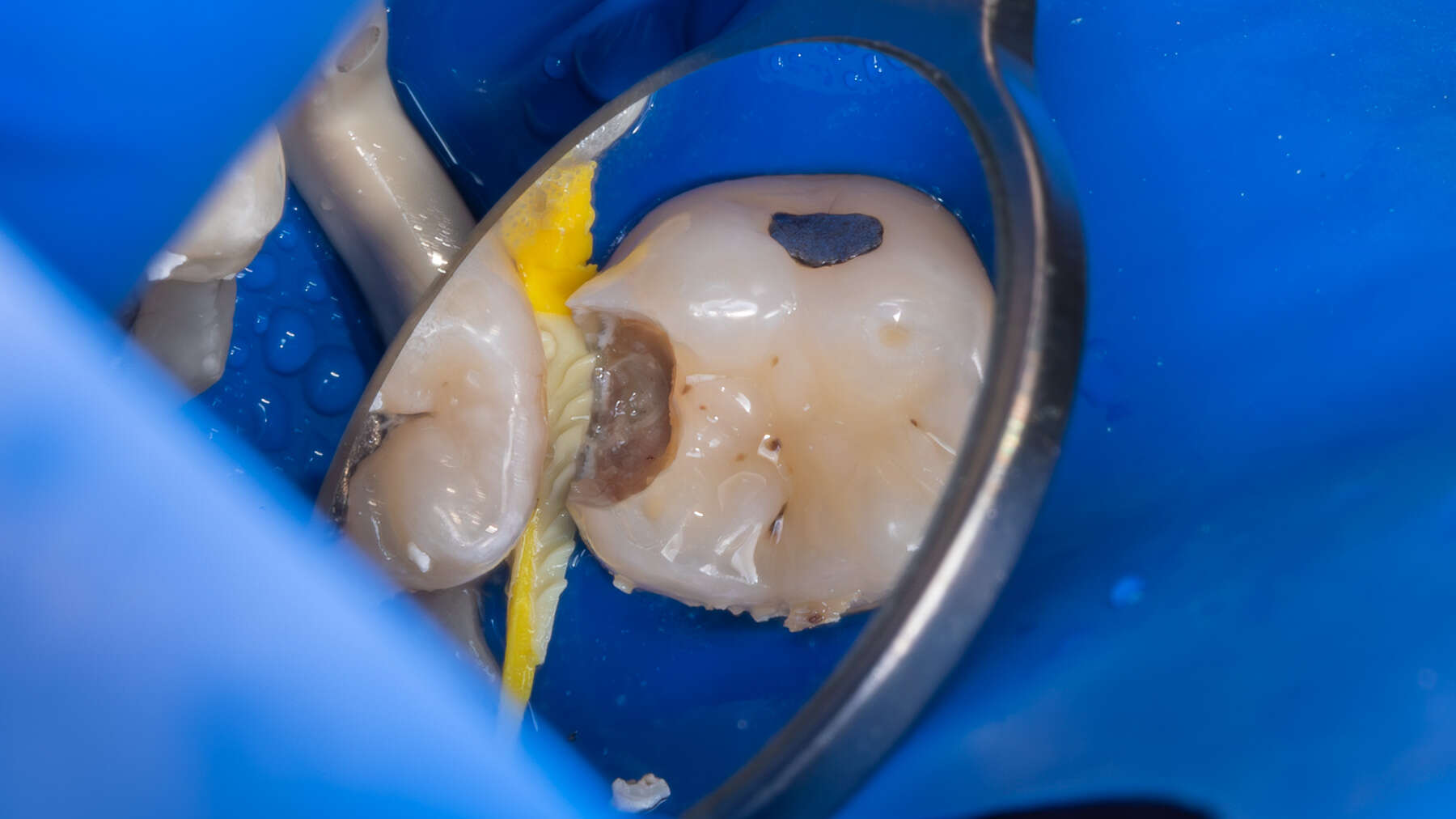 Vital pulp therapy (VPT) procedure, indications and clinical technique