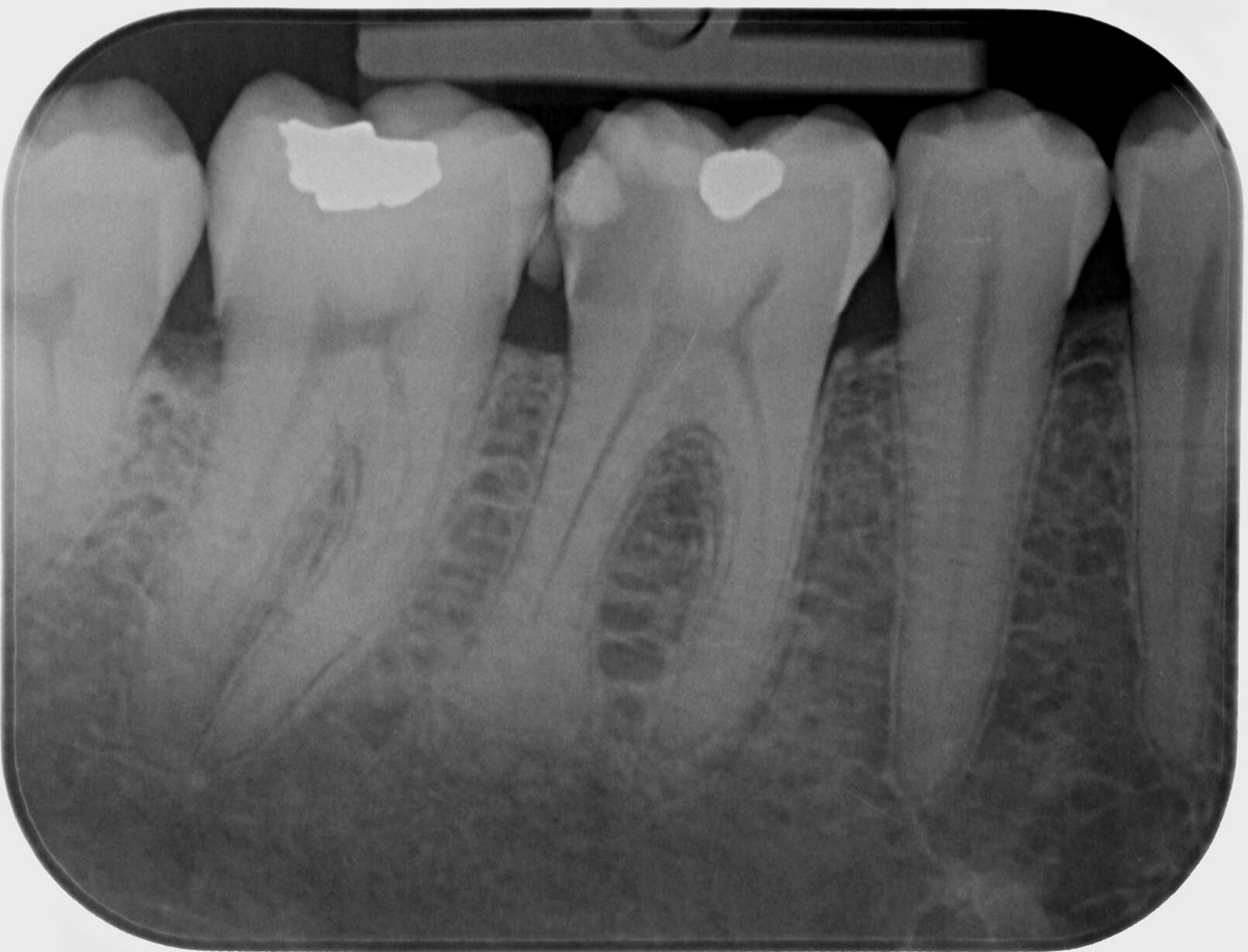 Vital pulp therapy (VPT) procedure, indications and clinical technique