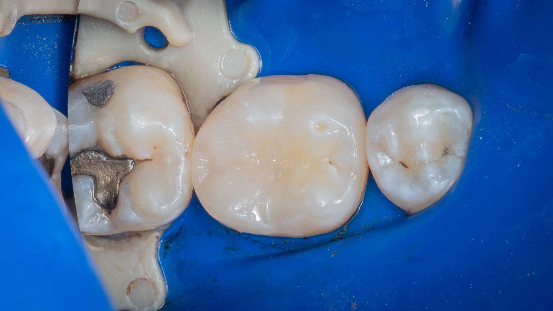 Vital pulp therapy (VPT) procedure, indications and clinical technique