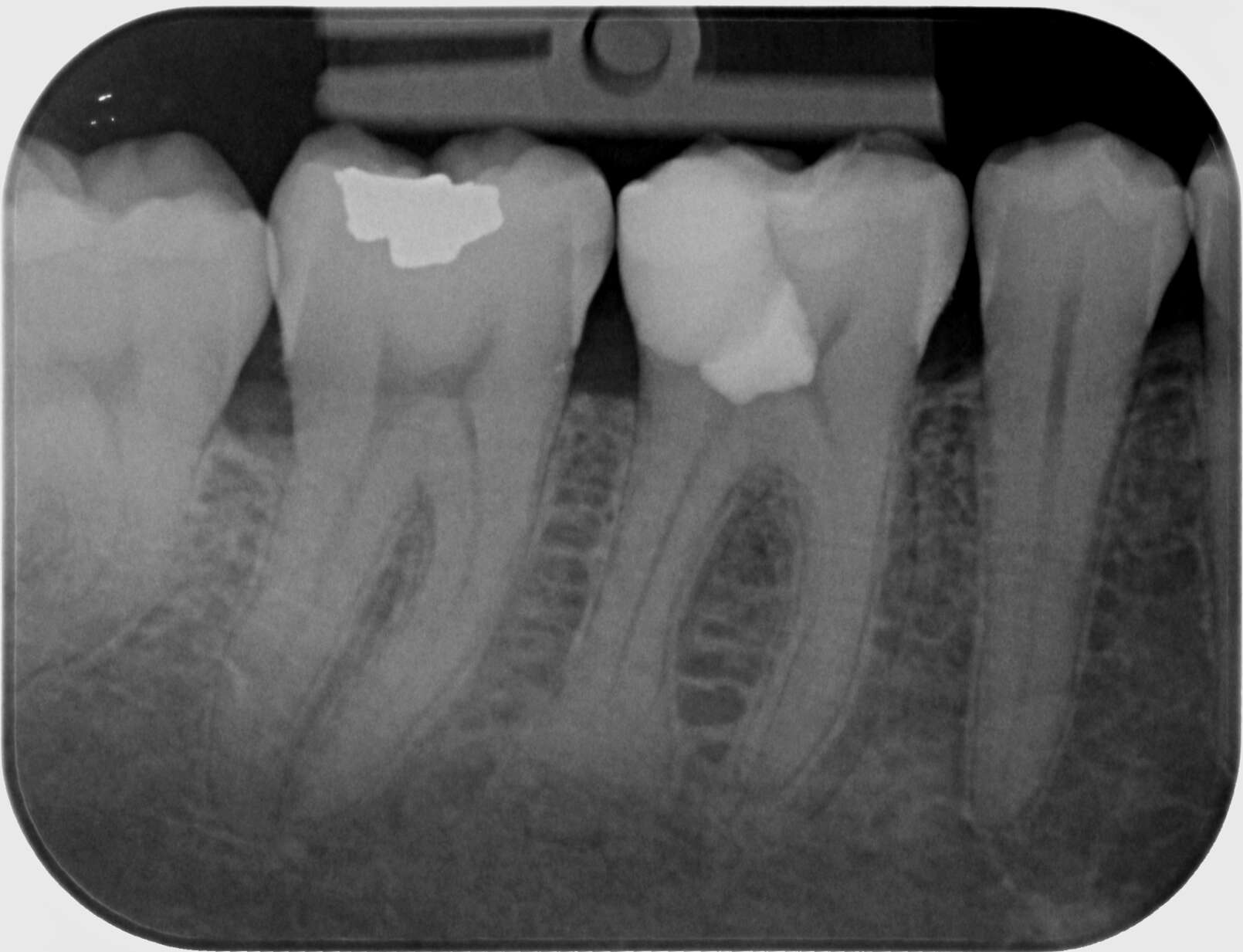 Vital pulp therapy (VPT) procedure, indications and clinical technique