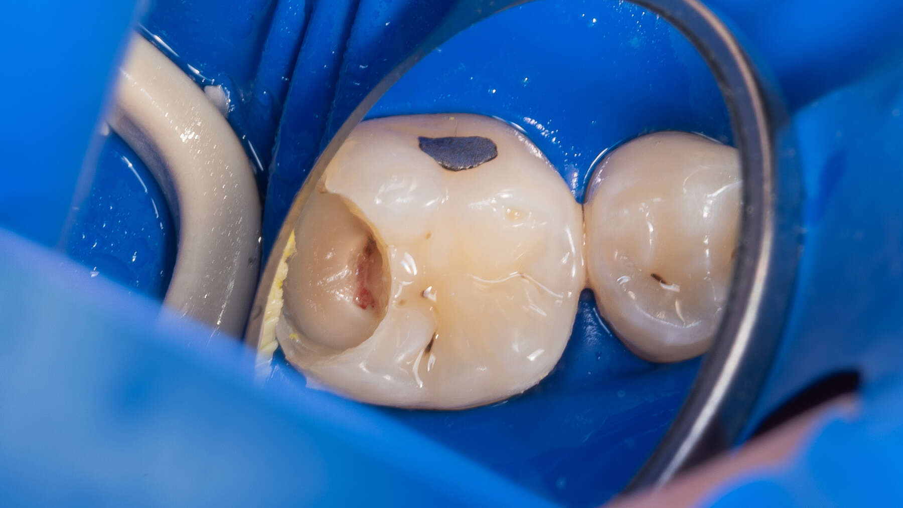 Vital pulp therapy (VPT) procedure, indications and clinical technique