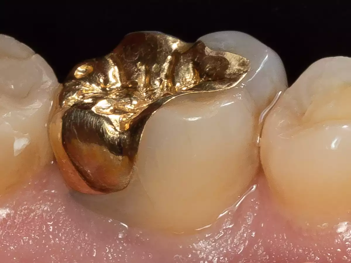 gold-ticks4dentists-2